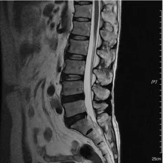 Fig. 3. L-spine MRI(sagittal view, 14.05.04)
