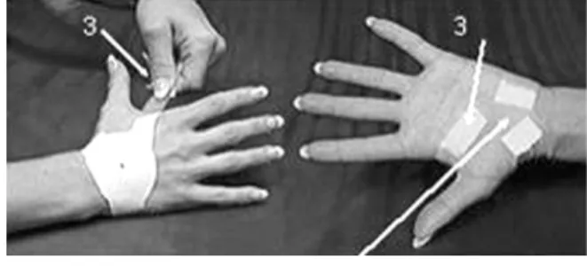 Fig. 3.  Carpal solution.