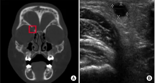Fig. 1. PNS CT scan. (A) The red  square outlines the 1.8 cm mass-  like soft tissue infiltration on the  inferior orbital wall