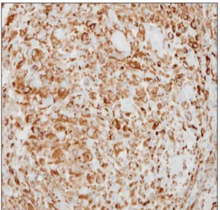 Fig. 3. Immunostaining of left calf nodule biopsy shows CD68  and CD163 positive cells.