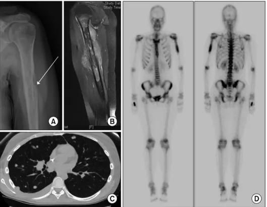 Fig. 2. Radiological presentation of Ewing sarcoma. X-ray shows  osteo-lytic lesion of bone and  involve-ment of the periosteal tissue (A)
