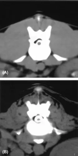 Fig. 5.  Transverse CT images obtained at L1-2, demonstrating normal paraspinal muscles (A) and paraspinal muscle atrophy (B).