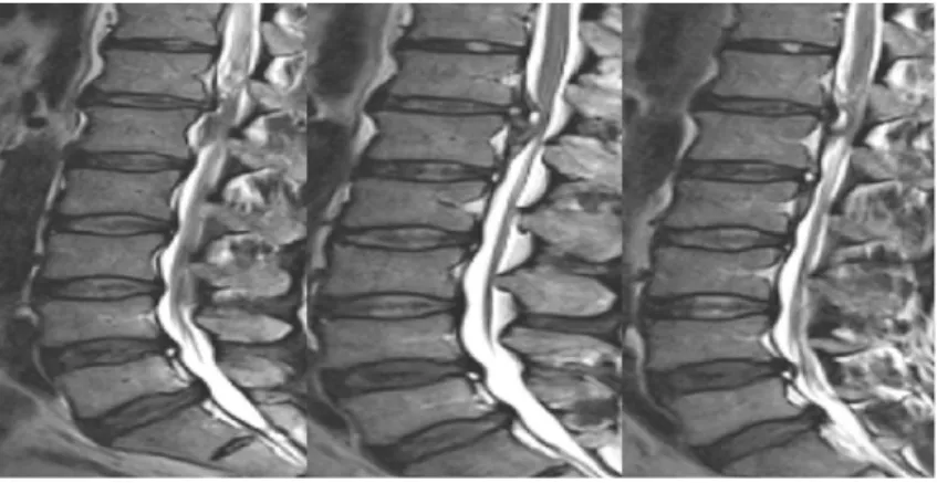 Fig. 2.  L-spine MRI (2009-10-05)