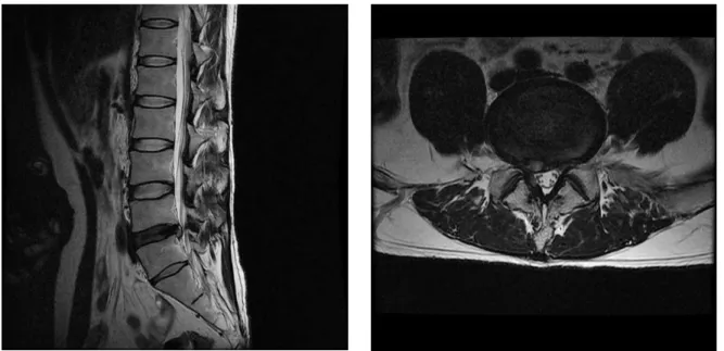 Fig. 3. L-spine mri(sagittal view, 2014.08.12). Fig. 4. L-spine mri(L4-5 axial view, 2014.08.12).