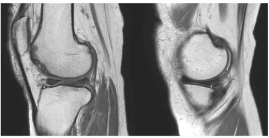 Fig. 3.  Both knee MRI of case 2.