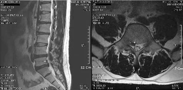 Fig. 1.  T2-weighted image of case 1 before treatment 