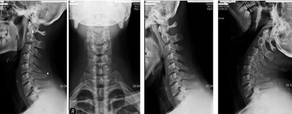 Fig. 1.  C-spine X-ray(AP/LAT/FLEX/EXT)