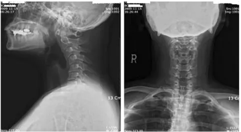 Fig. 5.  C-spine MRI (Sagittal view, C5/6,C6/7 Axial view)
