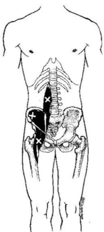 Fig. 1. Trigger points on iliopsoas muscles11).