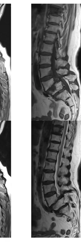 Fig. 2. L-spine mri with ctl.