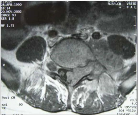 Fig.  2.  Midline  sagittal  T1-weighted  postgadolinium  MRI  image  of  the  lumbar  and  sacral  spine