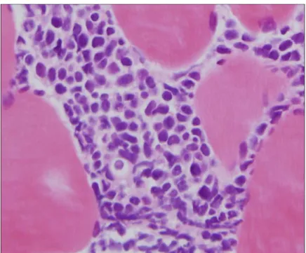 Fig.  3.  Wright-Giemsa  stain  of  the  biopsy  sample  shows  infiltrates  of  immature  lymphoblasts