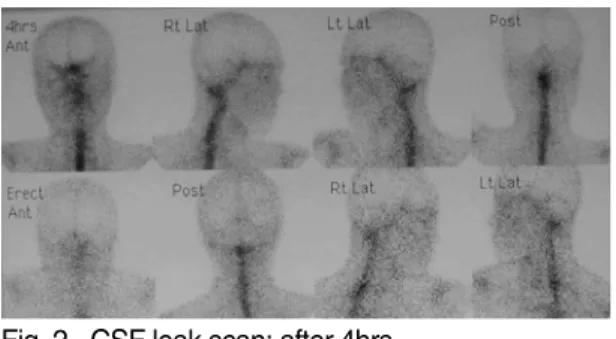 Fig. 1.  CSF leak scan: after 60min.