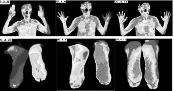 Table Ⅲ. Thermological Difference of between Hand and Foot  (unit : ℃) Right Left ΔT Hand Before 34.72 33.69 1.03 (勞宮) Med