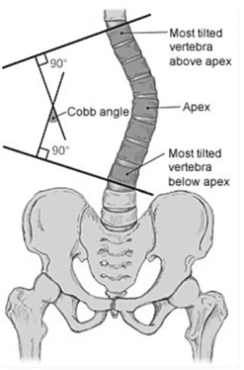 Fig. 1. Cobb’ s angle measurement 7) .