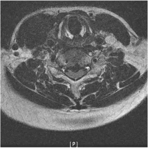 Fig. 1.  Cervical spine MRI(2008. 3. 19) Fig. 2.  Cervical spine MRI(2008. 3. 19)