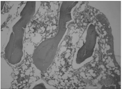Fig. 1. The bone marrow biopsy at initial diagnosis shows  hy-pocellular marrow with  fo-cal hematopoietic cells  (app-roximately 20% cellularity, H&amp;E stain, ×40).