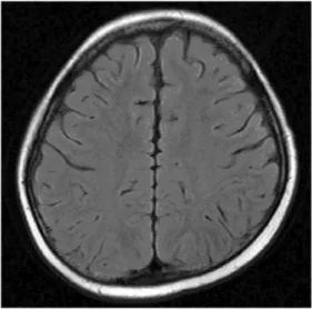 Fig. 2. MR examination of the brain taken 1 month later reveals resolution of previous lesion.