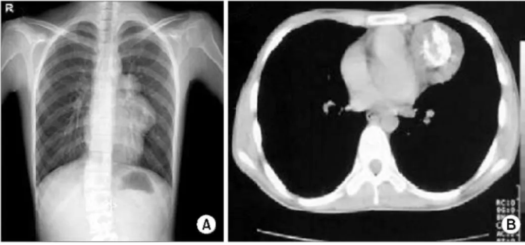 Fig. 1. (A) Chest PA on admission and (B) CT scan demonstrated a mass with calcifications in the left anterior mediastinum, measuring 5× 5× 5 cm.