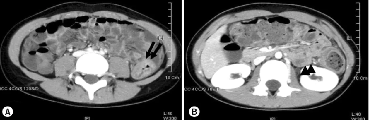 Fig. 1. Abdominal  CT  scan  demonstrates  a  concentric  bowel  wall  thickening  at  the  descending  colon  (arrows)  with  pericolic  infiltration  (A)