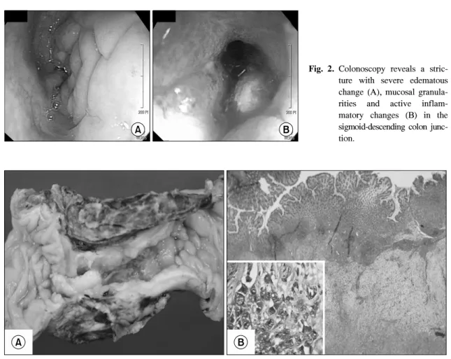 Fig. 2. Colonoscopy  reveals  a  stric- stric-ture  with  severe  edematous  change  (A),  mucosal   granula-rities  and  active   inflam-matory  changes  (B)  in  the  sigmoid-descending  colon   junc-tion.