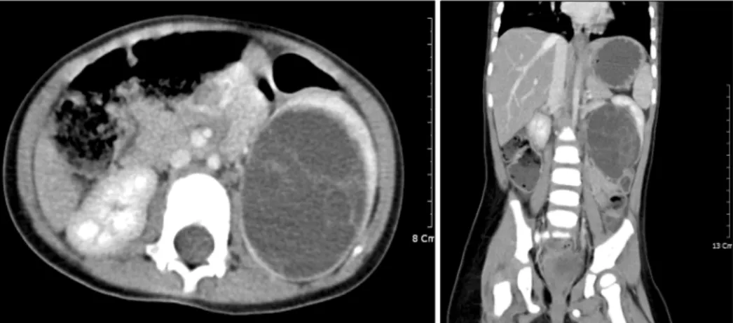 Fig.  4.  Microscopic  finding  shows  that  the  multiple  cytst  lined  with  squamous  epithelium