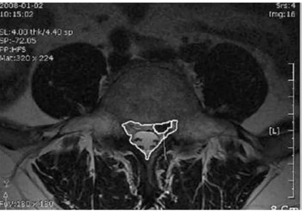 Fig. 1.  This MR image shows to measure the spinal canal dimension and herniated disc volume in pedicle level using CAD