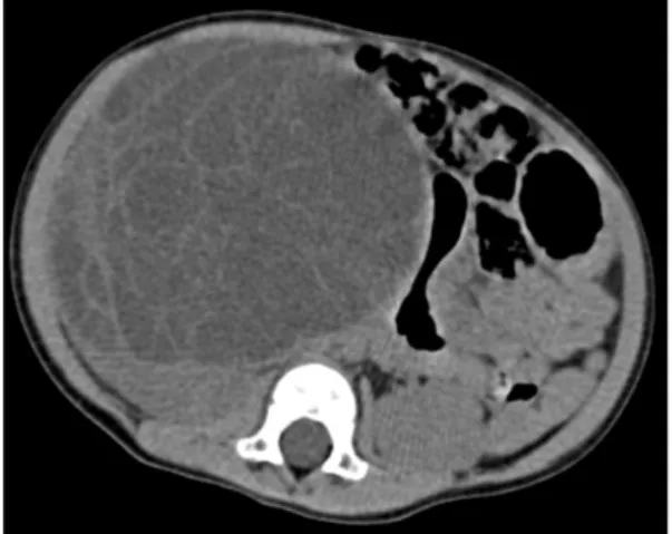 Fig.  1. Abdominal  computerized  tomography  shows  a  well-marginated  low  attenuation  multilocular   cy-stic  mass,  crossing  the  midline.