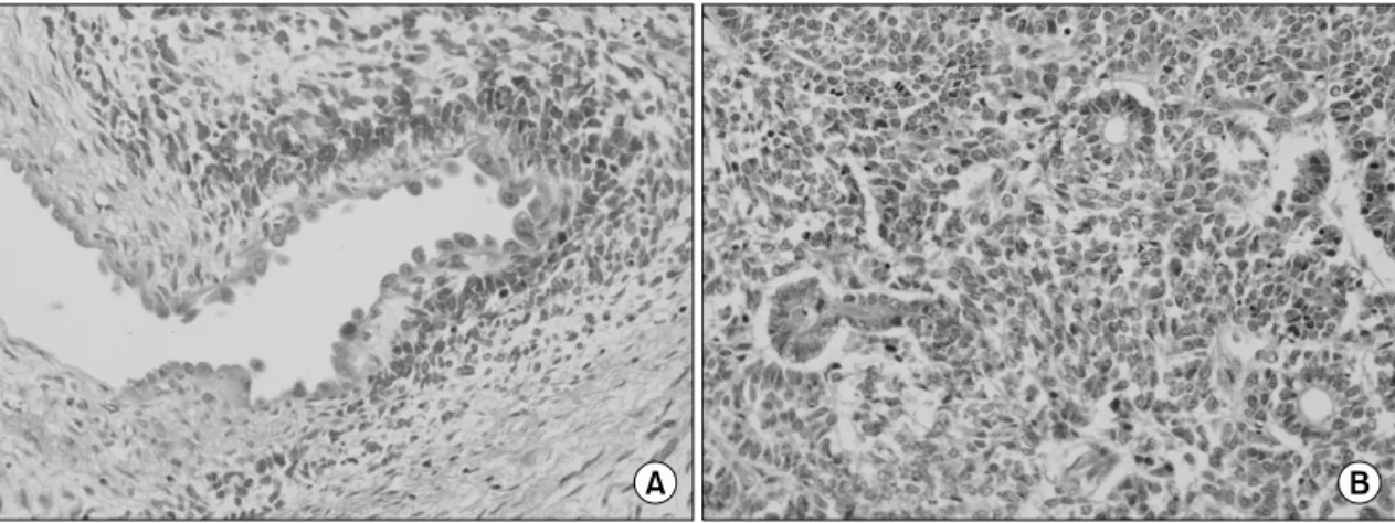 Fig.  3.  Microscopic  finding  shows  cystic  spaces  composed  of  fibrous  stromal  and  blastemal  elements  (A)