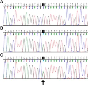 Fig.  3. p53  gene  sequencing  analysis  representing  mis- mis-sense  mutation  of  codon  273