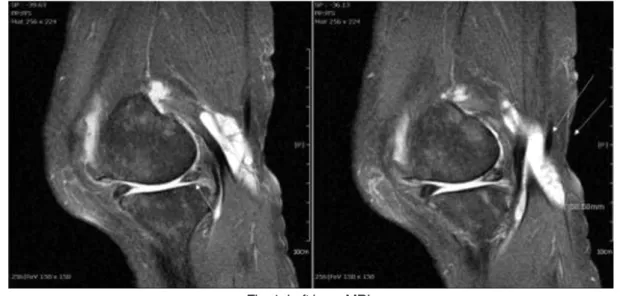 Fig. 1. Left knee MRI.