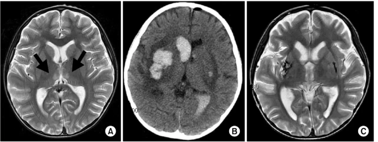 Fig.  2.  (A)  Brain  MRI  reveals  bilateral  symmetrical  hypersignal  intensities  in  the  medial  thalami  on  T2  weighted  image  which  is  suggestive  of  Wernicke's  encephalopathy
