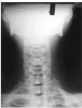 Fig. 3. Cervical Lateral ViewFig. 2. Cervical Anterioposterior View