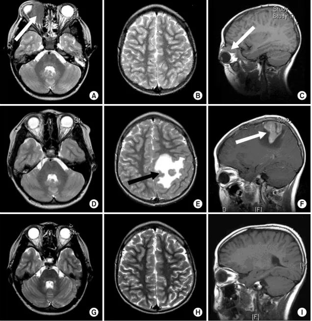 Fig.  1.  Brain  magnetic  resonance  images  (MRI)  of  the  patient.  Initial  T2  weighted  axial  image  (A,  B)  and  T1  weighted  sagittal  image  (C)  showed  a  right  retrobulbar  mass