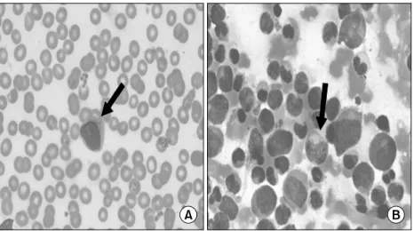 Fig.  2.  Initial  peripheral  blood  smear  (A)  and  bone  marrow  aspiration  (B)  of  the  patient