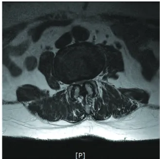 Fig. 5. Sagittal T2WI of Case 2. Fig. 6. Transverse T2WI of Case 2; L3/4.
