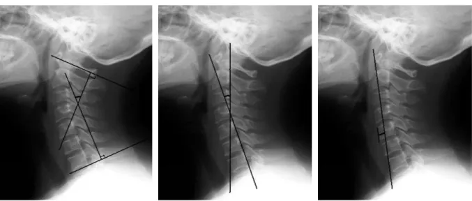 Fig. 1.  Cervical angle. Fig. 2.  Jackson s angle.  Fig. 3. Jochumsen method. 
