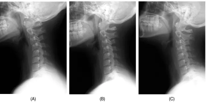 Fig. 5.  The change of cervical curvature in C-spine lat. view.