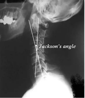 Fig. 1.   Cervical angle.  Fig. 2.  Jackson's angle.