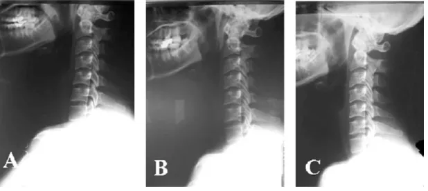 Fig. 7.   The change of cervical curvature in C-spine lat. view.