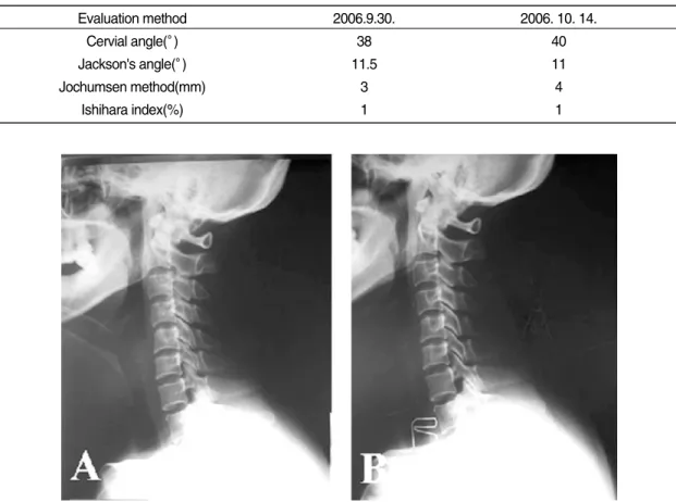 Fig. 9.  The change of cervical curvature in C-spine lat. view.