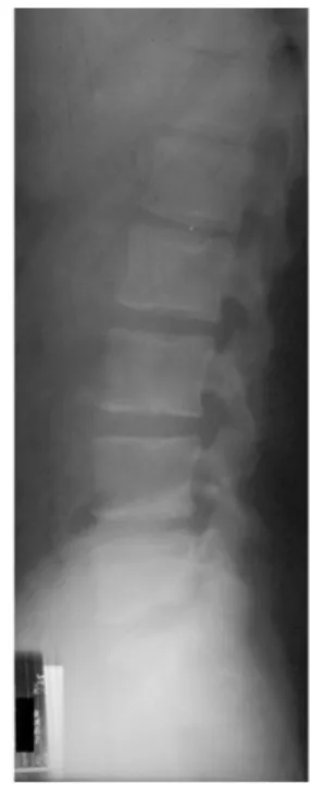 Fig. 1.  AP view of L-spine Fig. 2.  Lateral view of L-spine