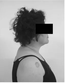 Fig. 1.  Lt. shoulder MRI (2008. 10. 20)