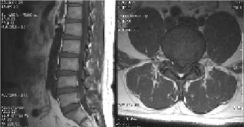 Fig. 3.  T1-weighted image with Extruded disc at L5-S1