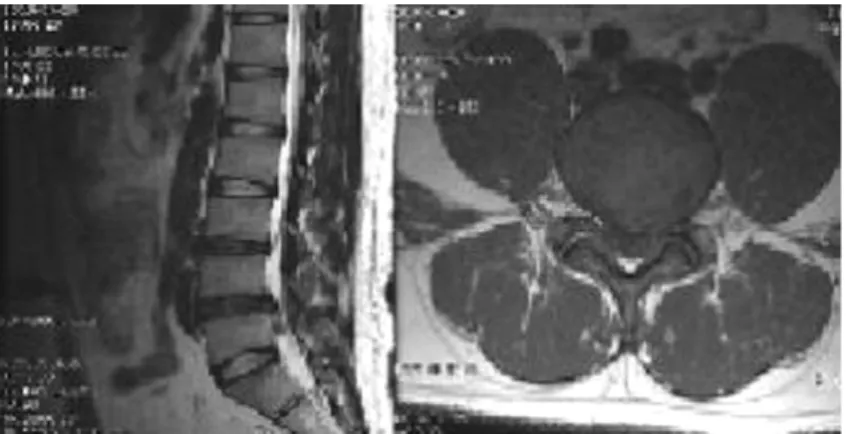 Fig. 4.  T2-weighted image with Extruded disc at L5-S1