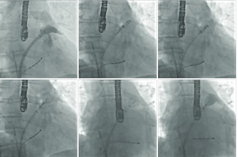 Figure 7. WaveCrest deployment. Step-by-step procedure as seen on fluoroscopy. See text for description