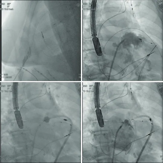 Figure 8. Lariat deployment. Step-by-step procedure as seen on fluoroscopy. See text for description.