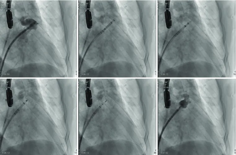 Figure 5. Watchman deployment. Step-by-step procedure as seen on fluoroscopy. See text for description