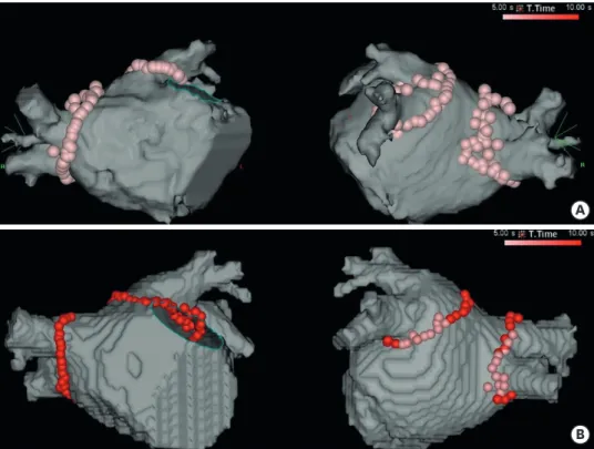 Figure 2. Representative examples of HPSD ablation. (A) shows an example of a patient who underwent PVI using  the initial 5-second protocol