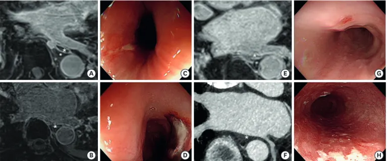 Figure 3. MR images, computed tomographic images, and endoscopic findings of patients with esophageal complications